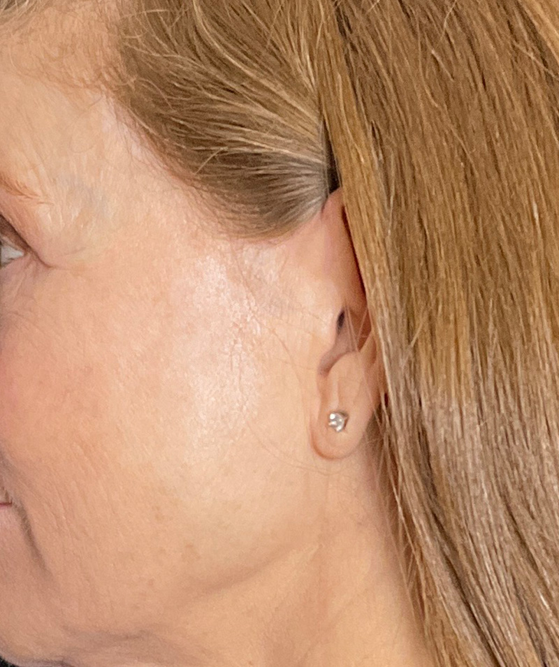 Facelift Before and After | PERK Plastic Surgery