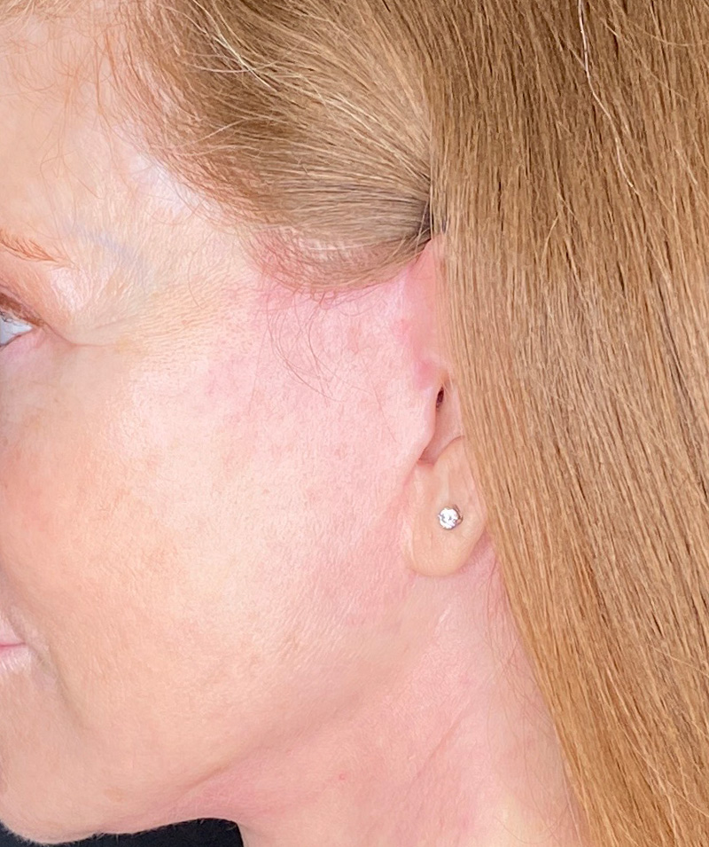 Facelift Before and After | PERK Plastic Surgery