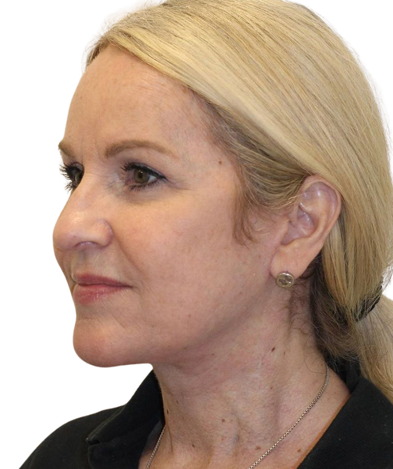 Facelift Before and After | PERK Plastic Surgery