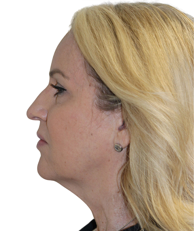 Facelift Before and After | PERK Plastic Surgery