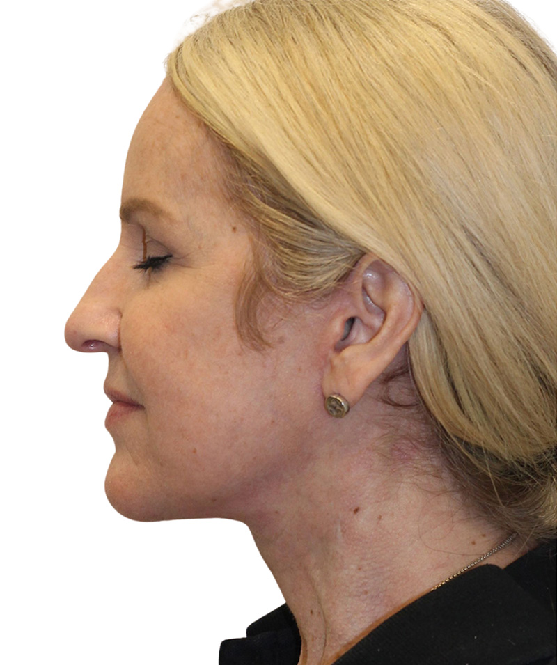 Facelift Before and After | PERK Plastic Surgery