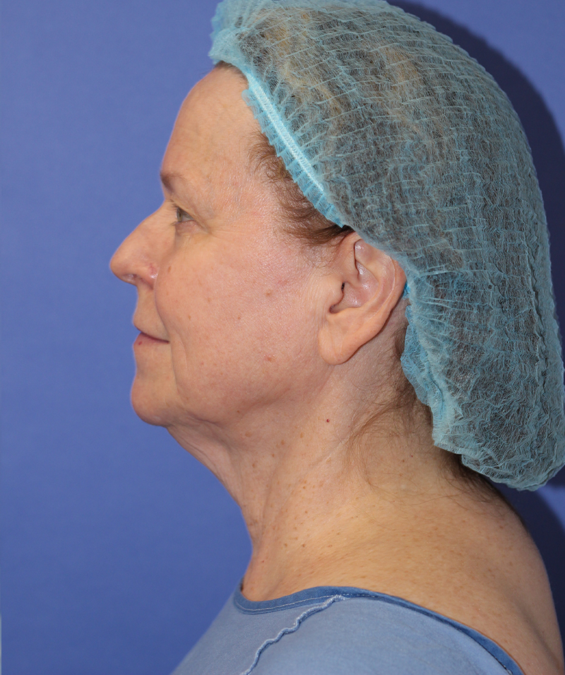 Facelift Before and After | PERK Plastic Surgery