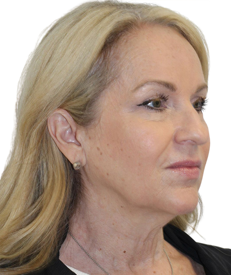 Facelift Before and After | PERK Plastic Surgery