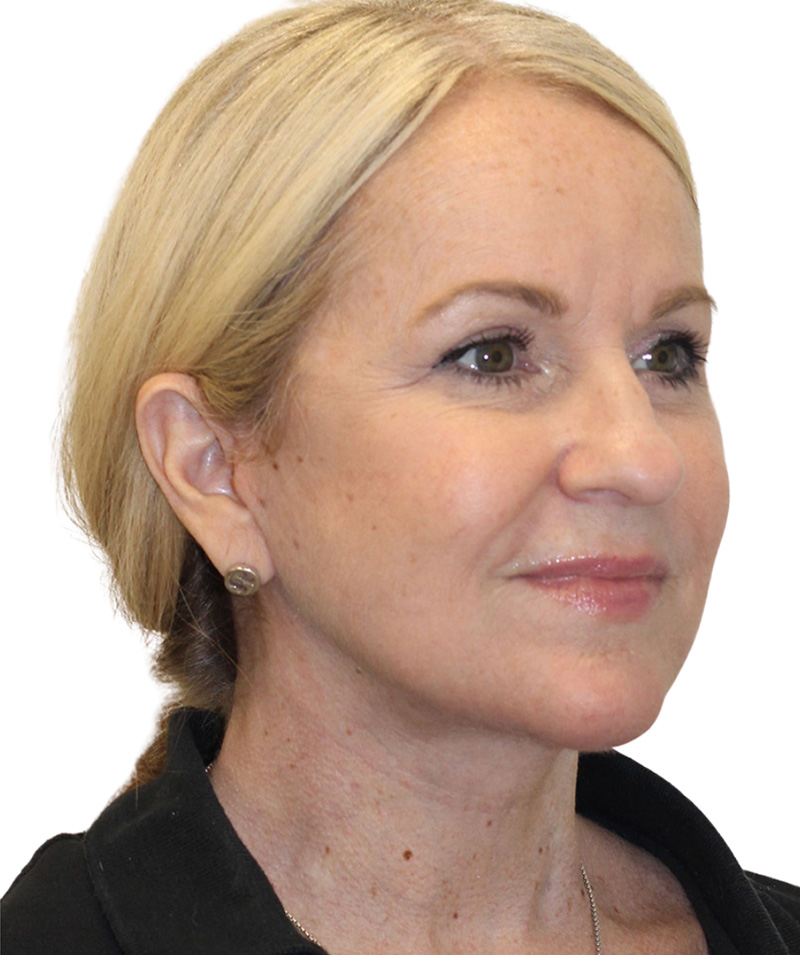 Facelift Before and After | PERK Plastic Surgery