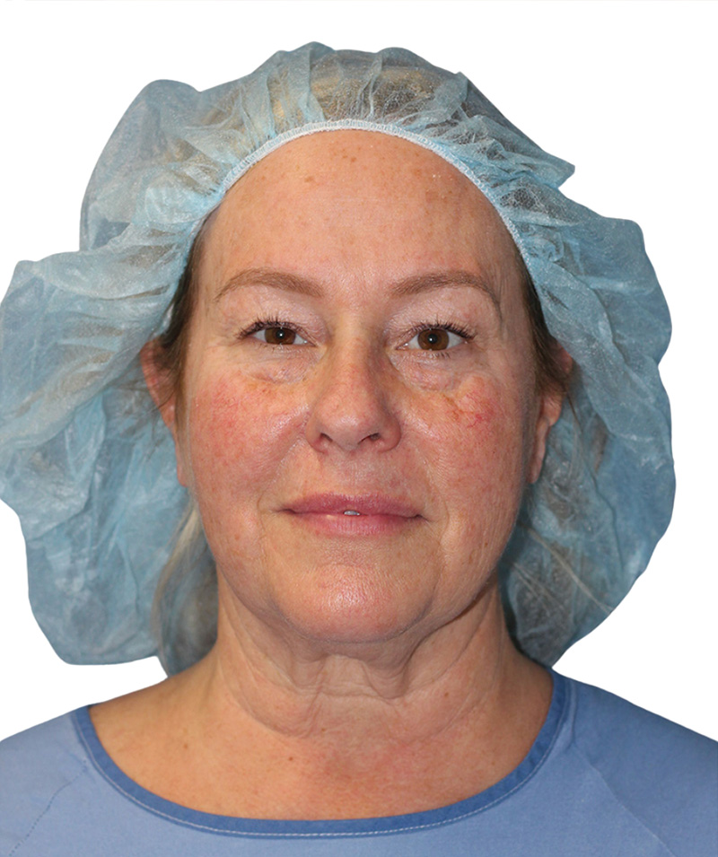 Facial Fat Grafting Beverly Hills