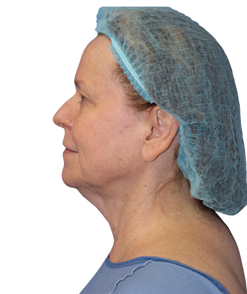 Facelift Before and After | PERK Plastic Surgery