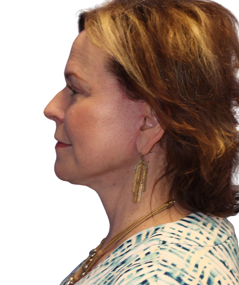 Facelift Before and After | PERK Plastic Surgery