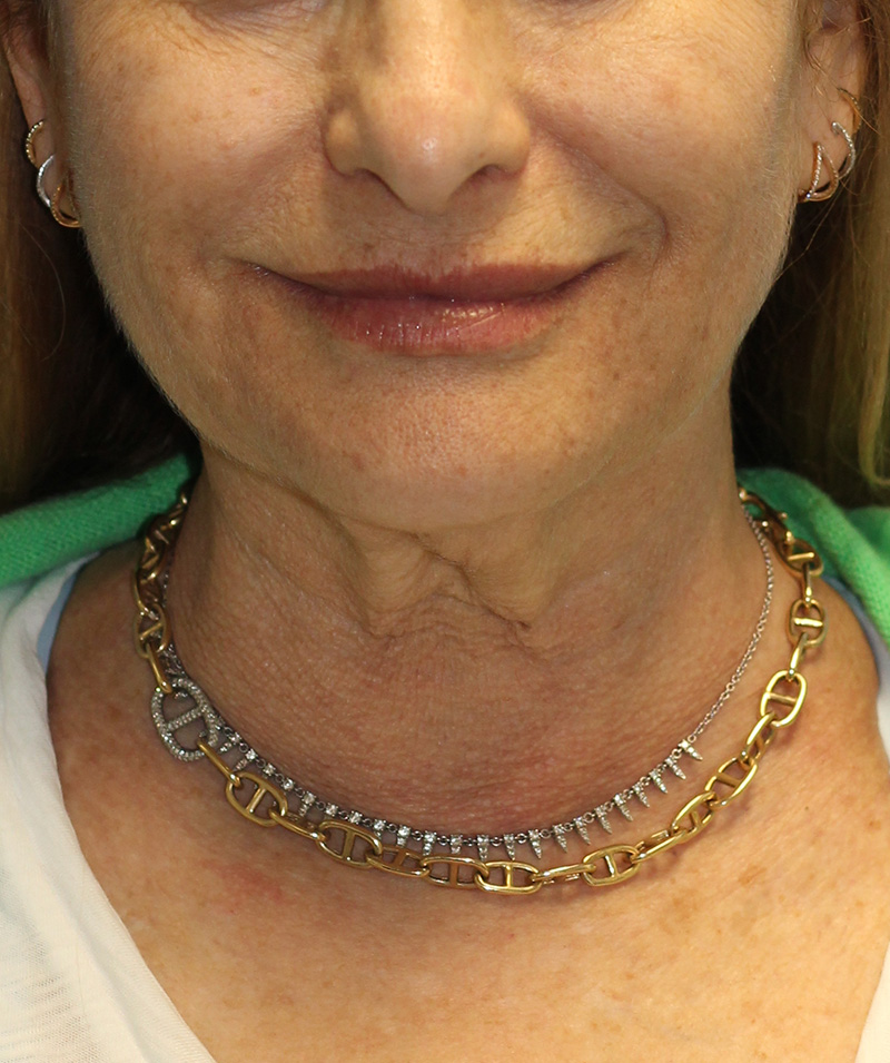 Facelift Before and After | PERK Plastic Surgery