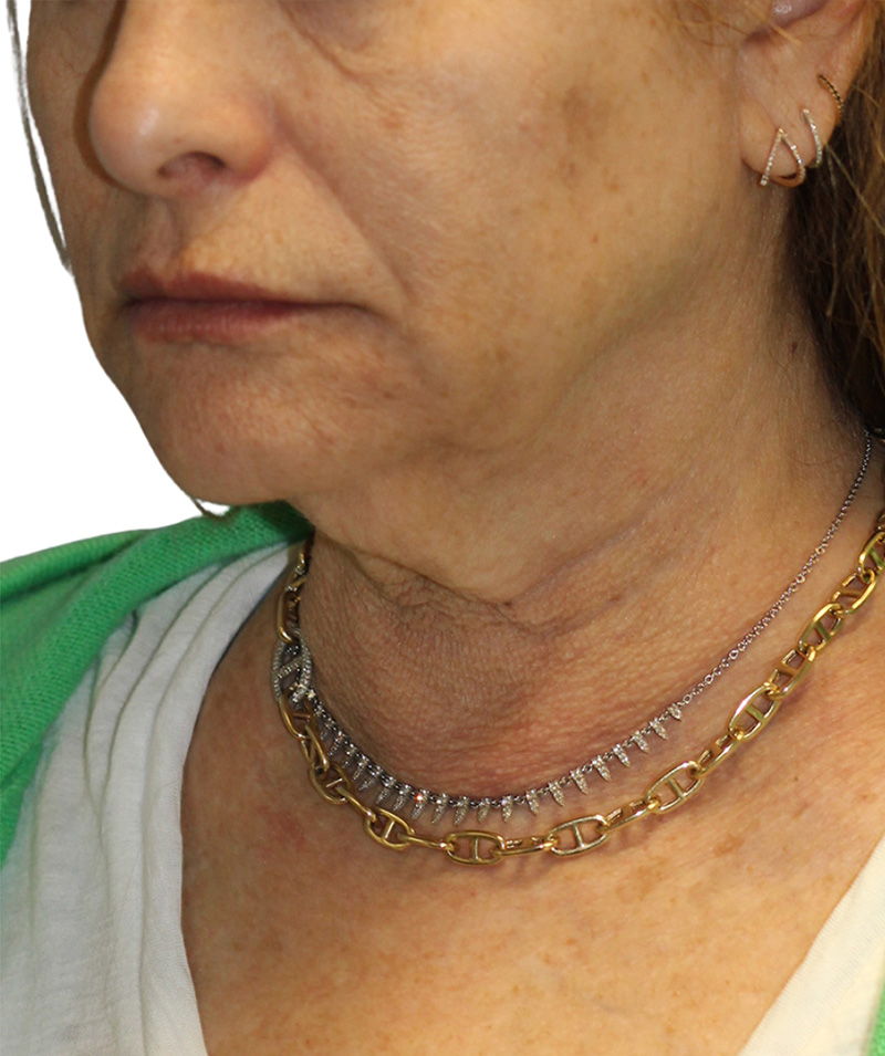 Facelift Before and After | PERK Plastic Surgery