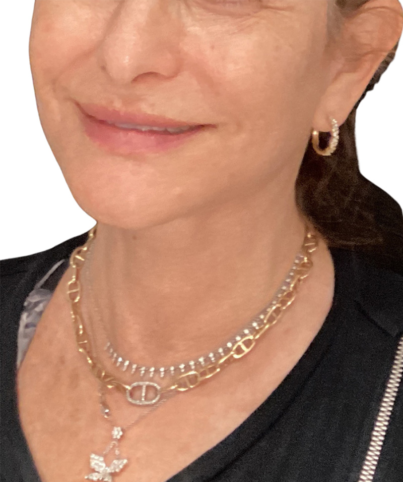 Facelift Before and After | PERK Plastic Surgery
