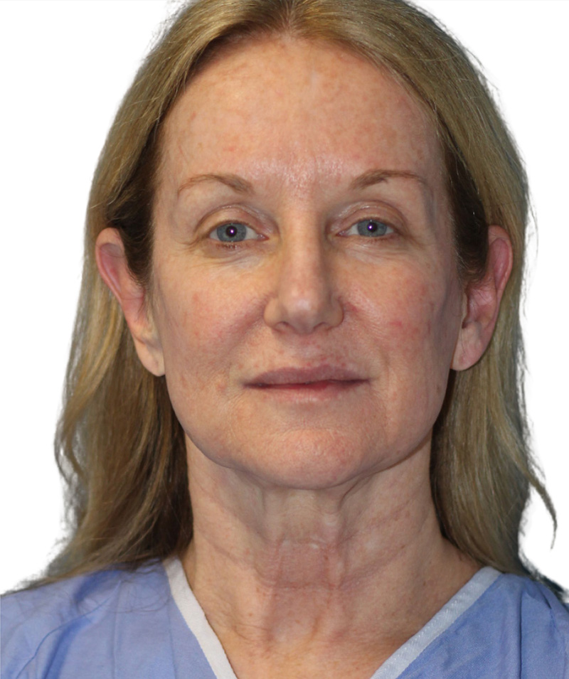 Facelift Before and After | PERK Plastic Surgery