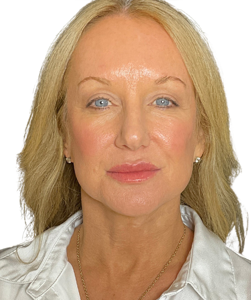 Facelift Before and After | PERK Plastic Surgery