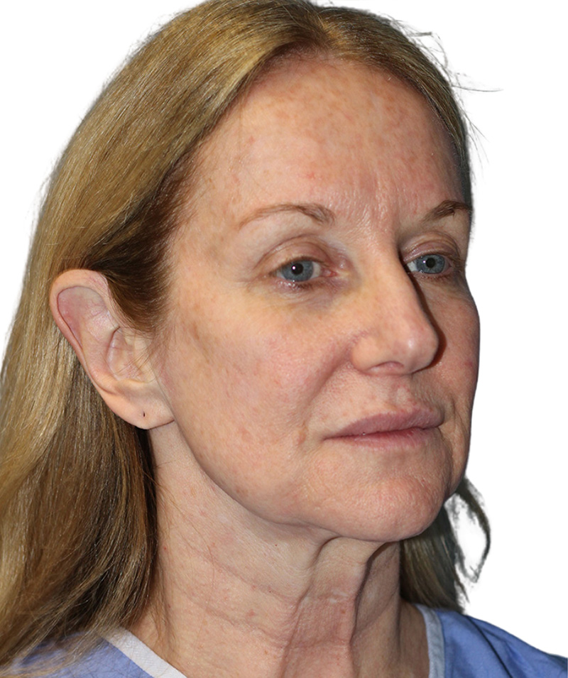 Facelift Before and After | PERK Plastic Surgery