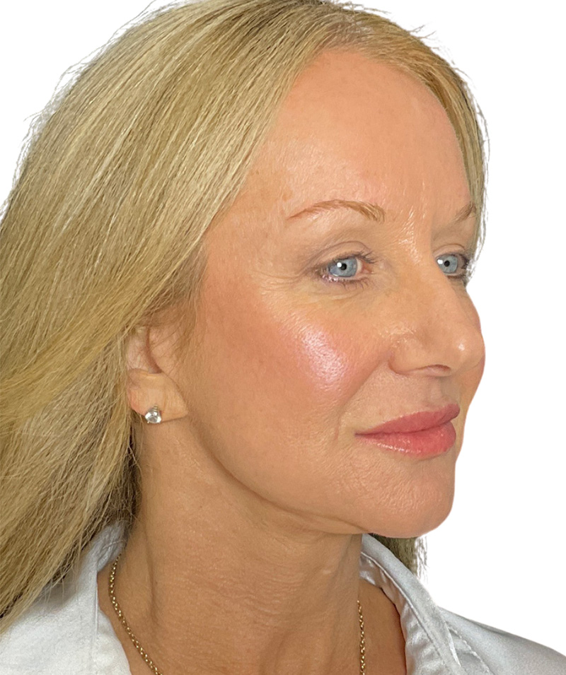 Facelift Before and After | PERK Plastic Surgery