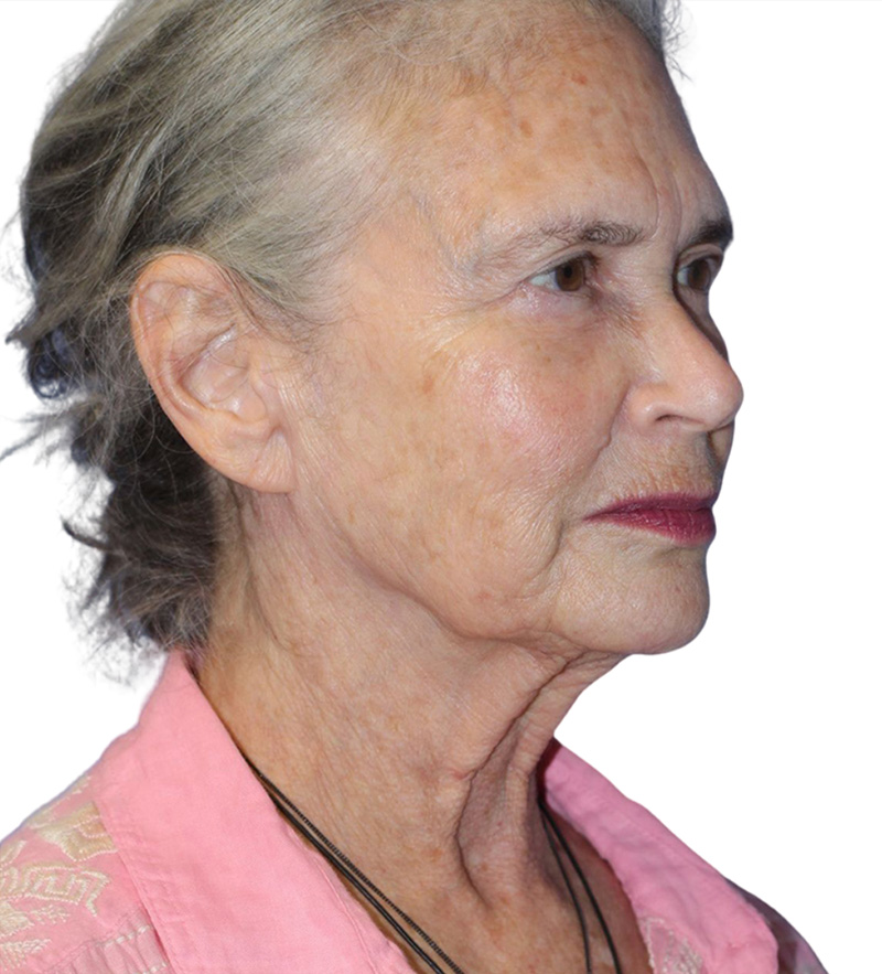 Facelift Before and After | PERK Plastic Surgery