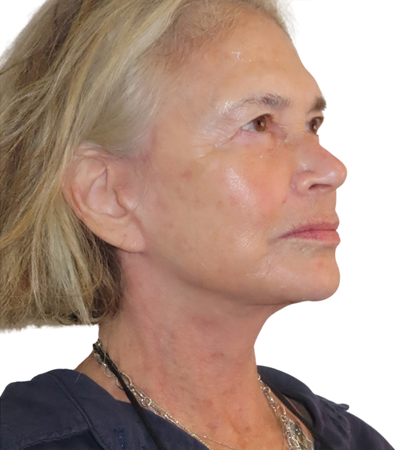 Facelift Before and After | PERK Plastic Surgery