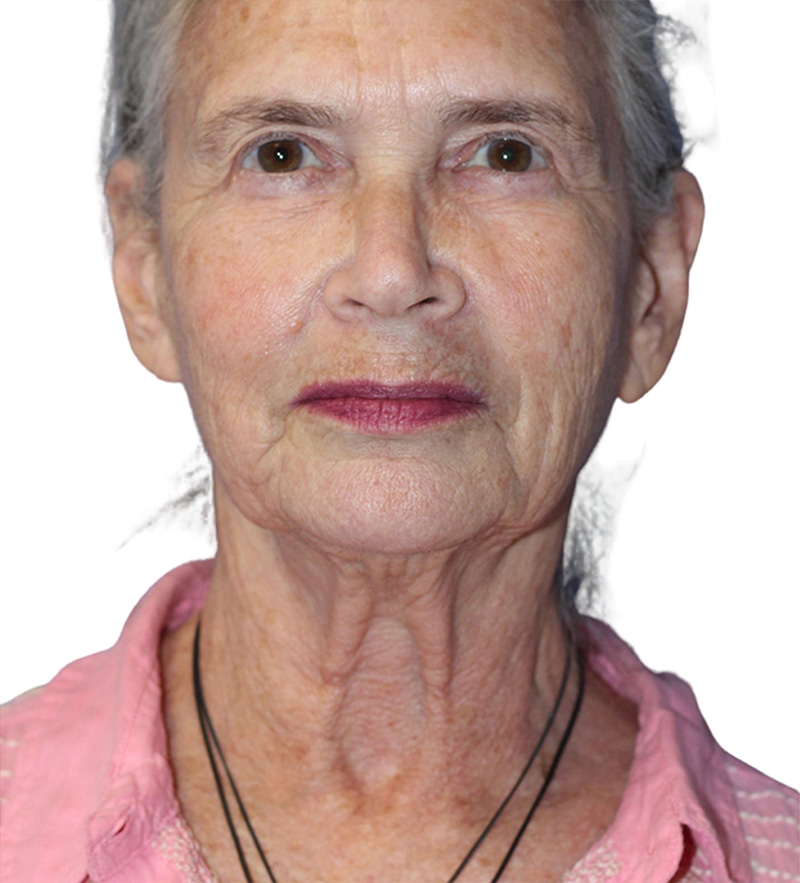 Facelift Before and After | PERK Plastic Surgery