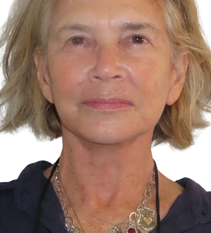 Facelift Before and After | PERK Plastic Surgery