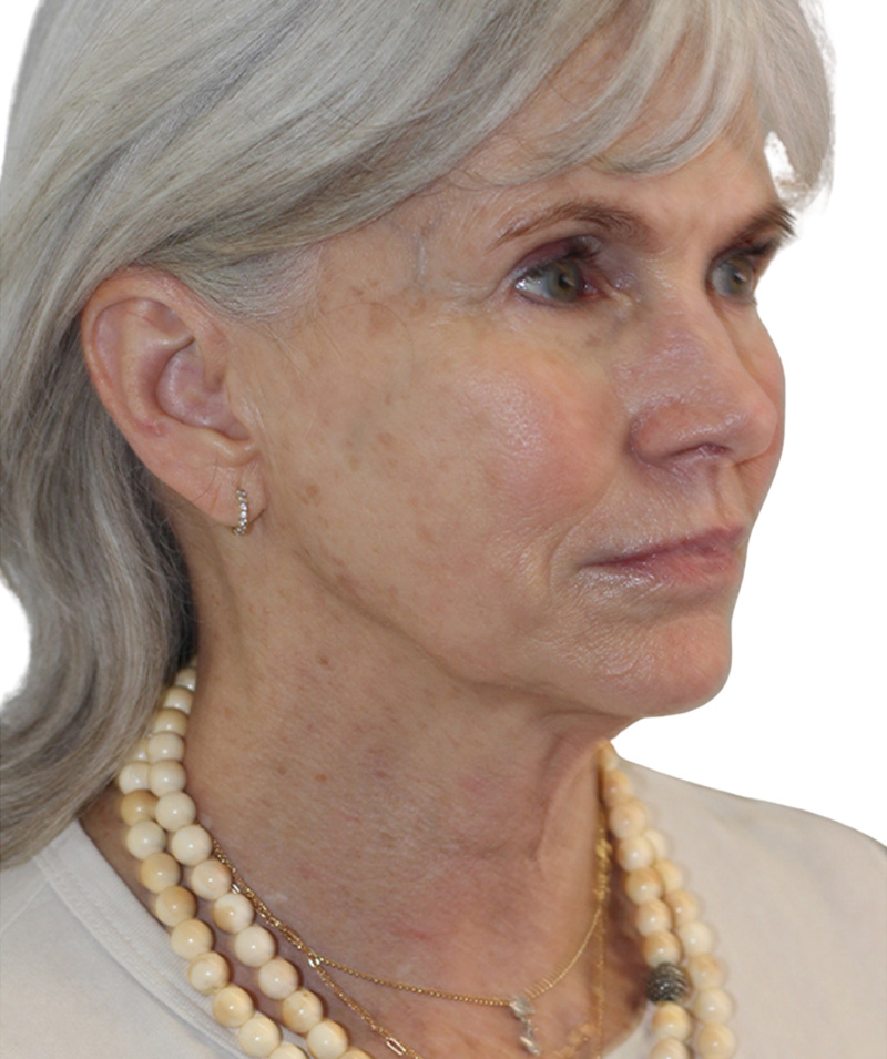 Facelift Before and After | PERK Plastic Surgery