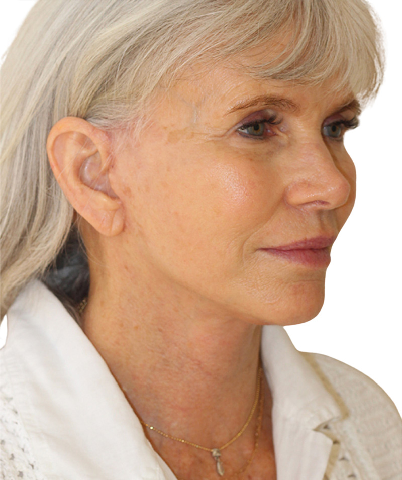 Facelift Before and After | PERK Plastic Surgery