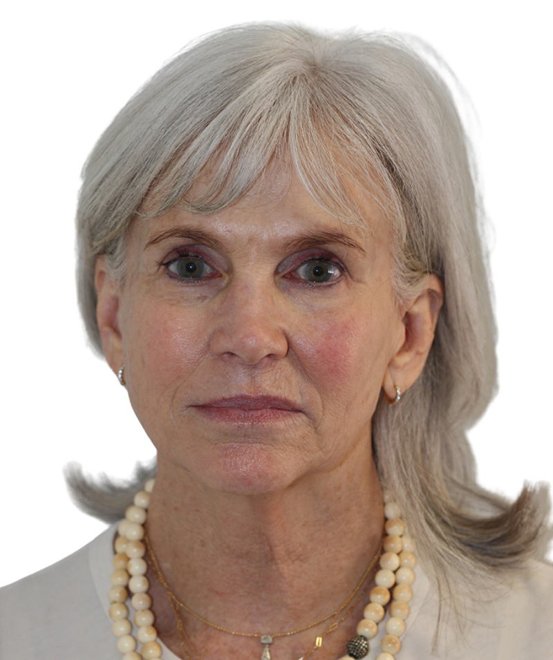 Facelift Before and After | PERK Plastic Surgery