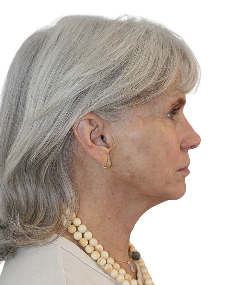 Facelift Before and After | PERK Plastic Surgery