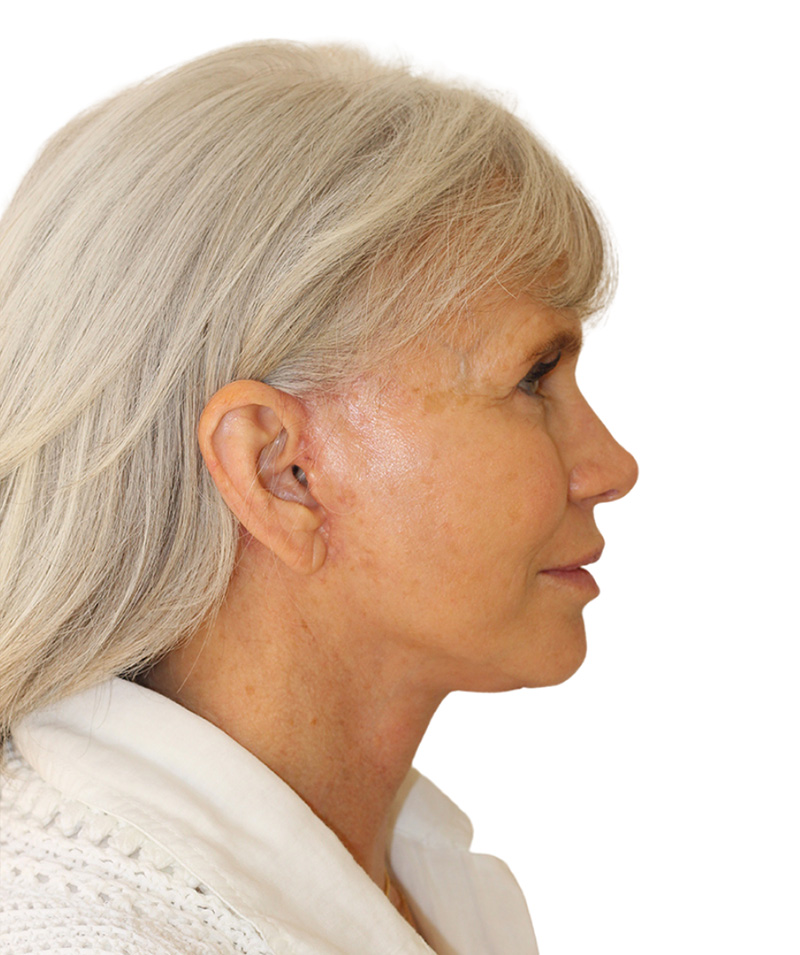 Facelift Before and After | PERK Plastic Surgery