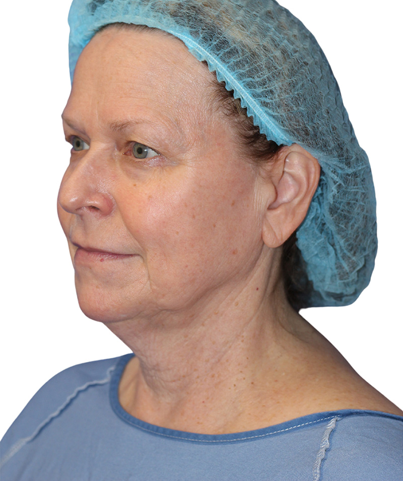 Facelift Before and After | PERK Plastic Surgery