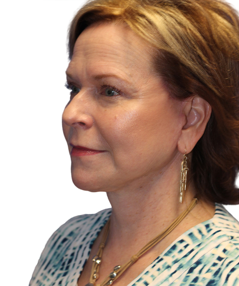 Facelift Before and After | PERK Plastic Surgery
