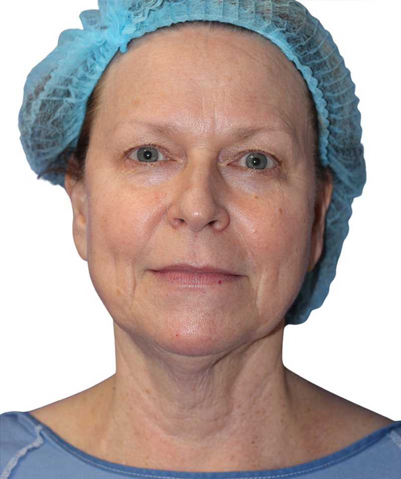 Facelift Before and After | PERK Plastic Surgery