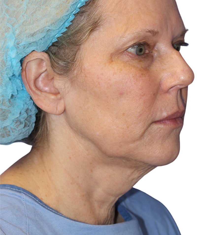 Facelift Before and After | PERK Plastic Surgery
