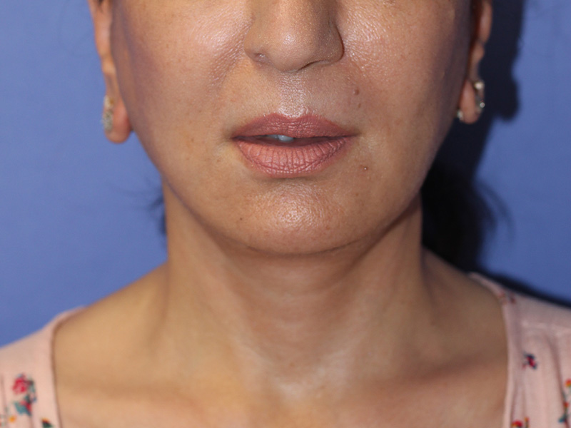 Facelift Before and After | PERK Plastic Surgery
