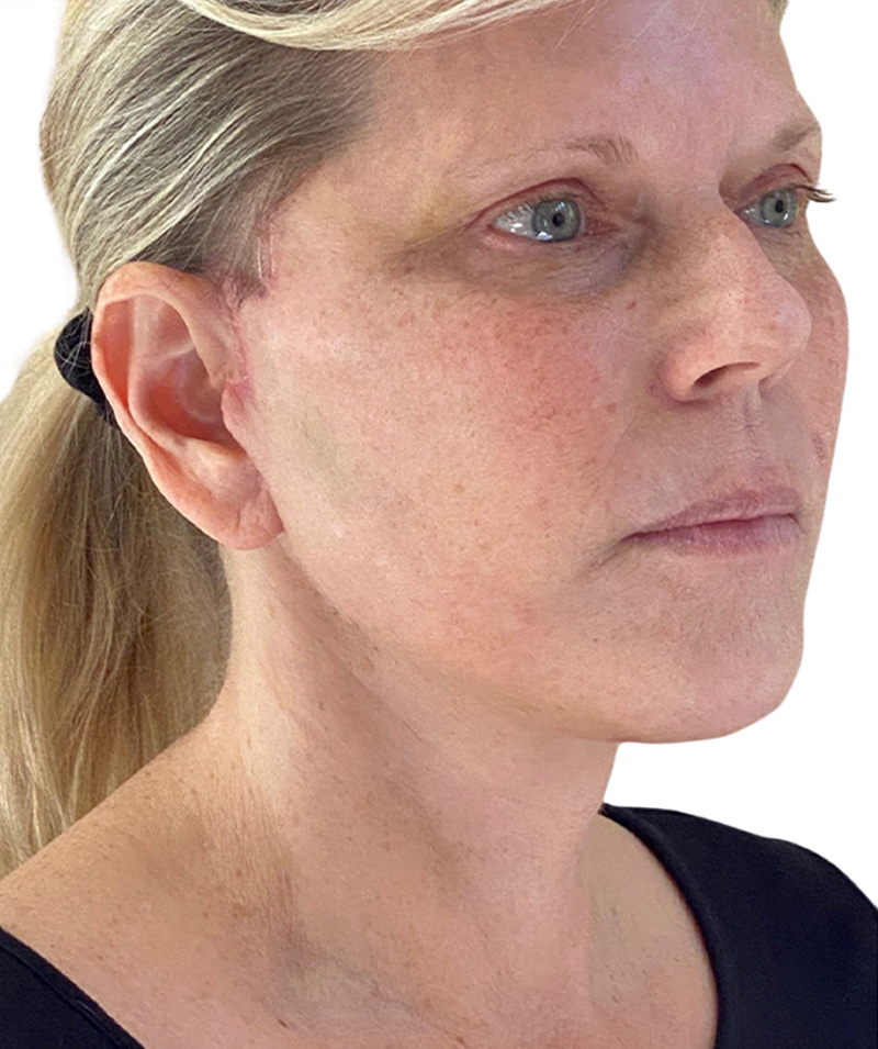 Facelift Before and After | PERK Plastic Surgery