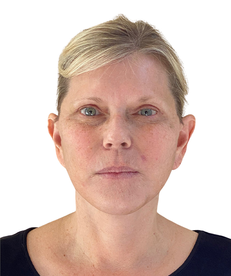 Facelift Before and After | PERK Plastic Surgery