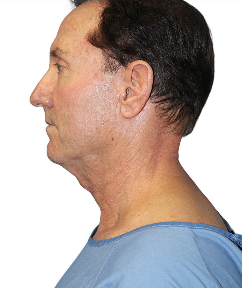 Facelift Before and After | PERK Plastic Surgery