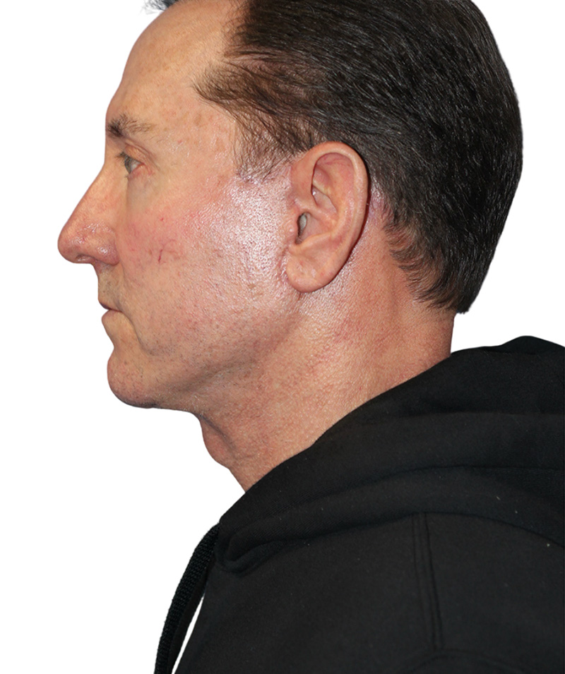 Facelift Before and After | PERK Plastic Surgery