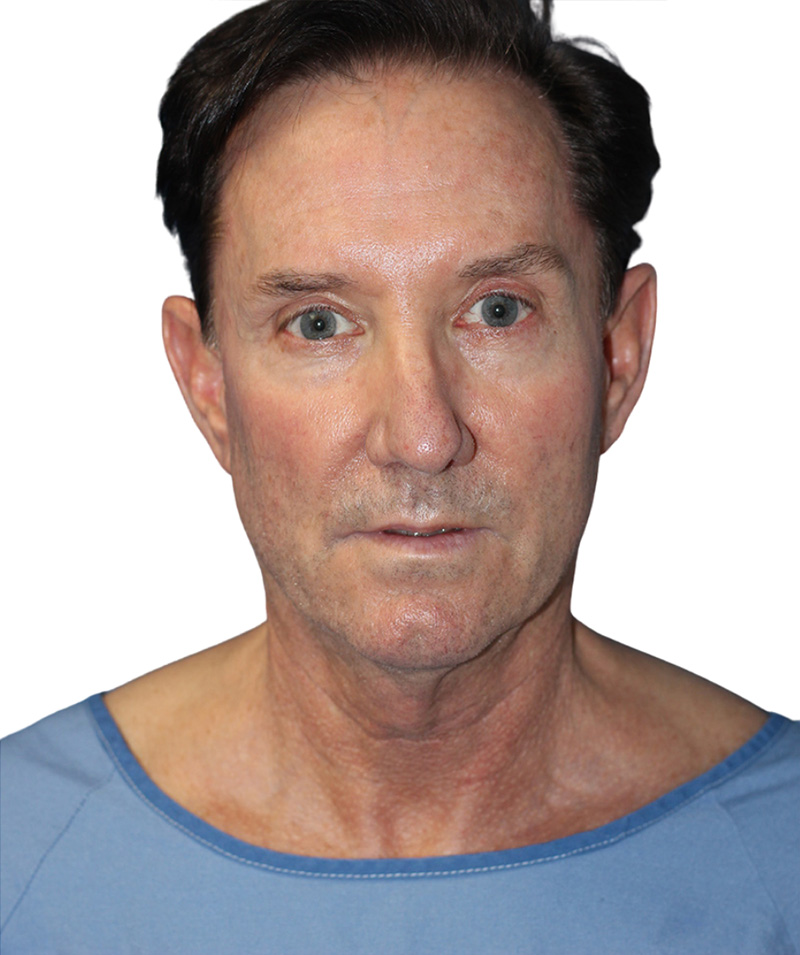Facelift Before and After | PERK Plastic Surgery