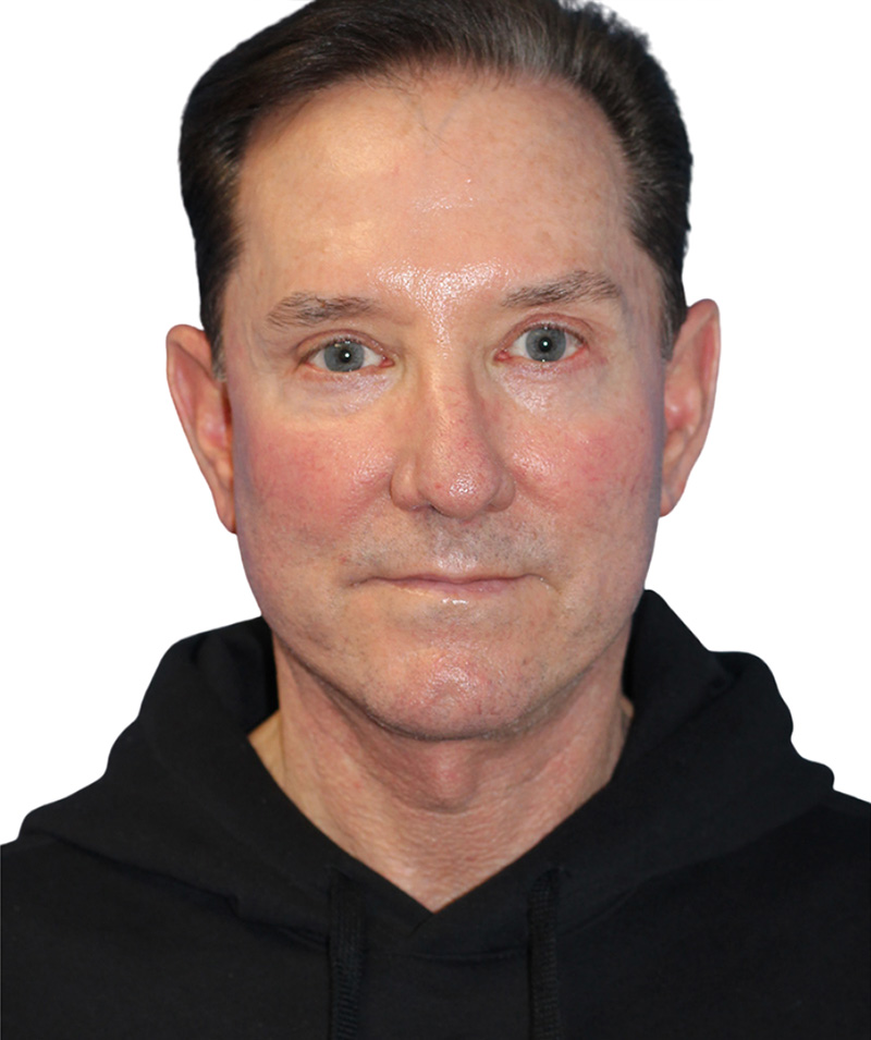 Facelift Before and After | PERK Plastic Surgery