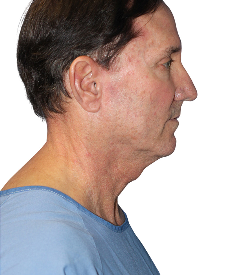 Facelift Before and After | PERK Plastic Surgery