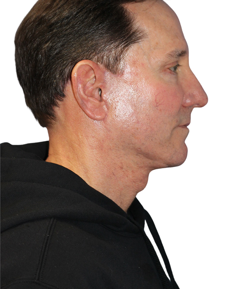Facelift Before and After | PERK Plastic Surgery
