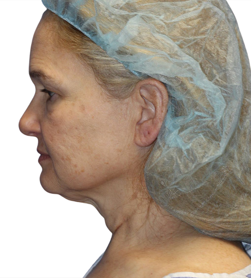 Facelift Before and After | PERK Plastic Surgery