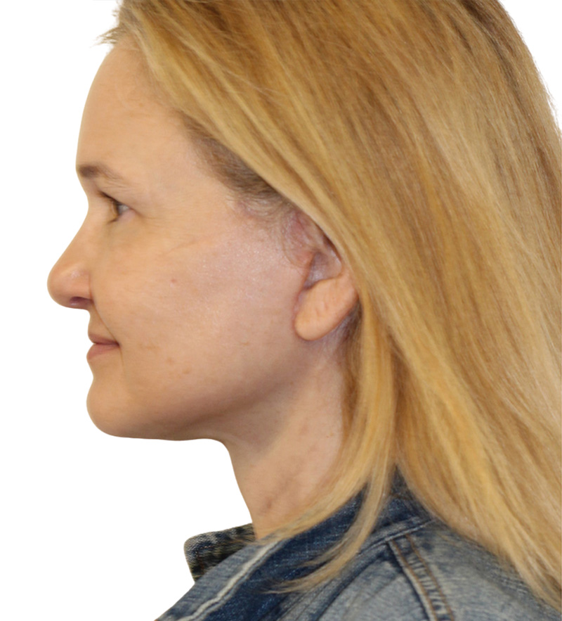 Facelift Before and After | PERK Plastic Surgery