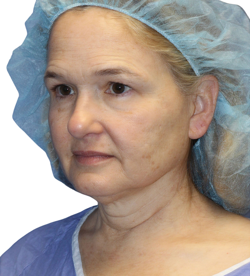 Facelift Before and After | PERK Plastic Surgery