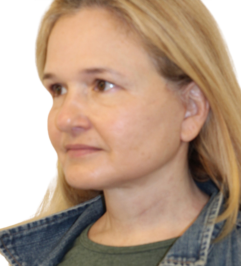 Facelift Before and After | PERK Plastic Surgery