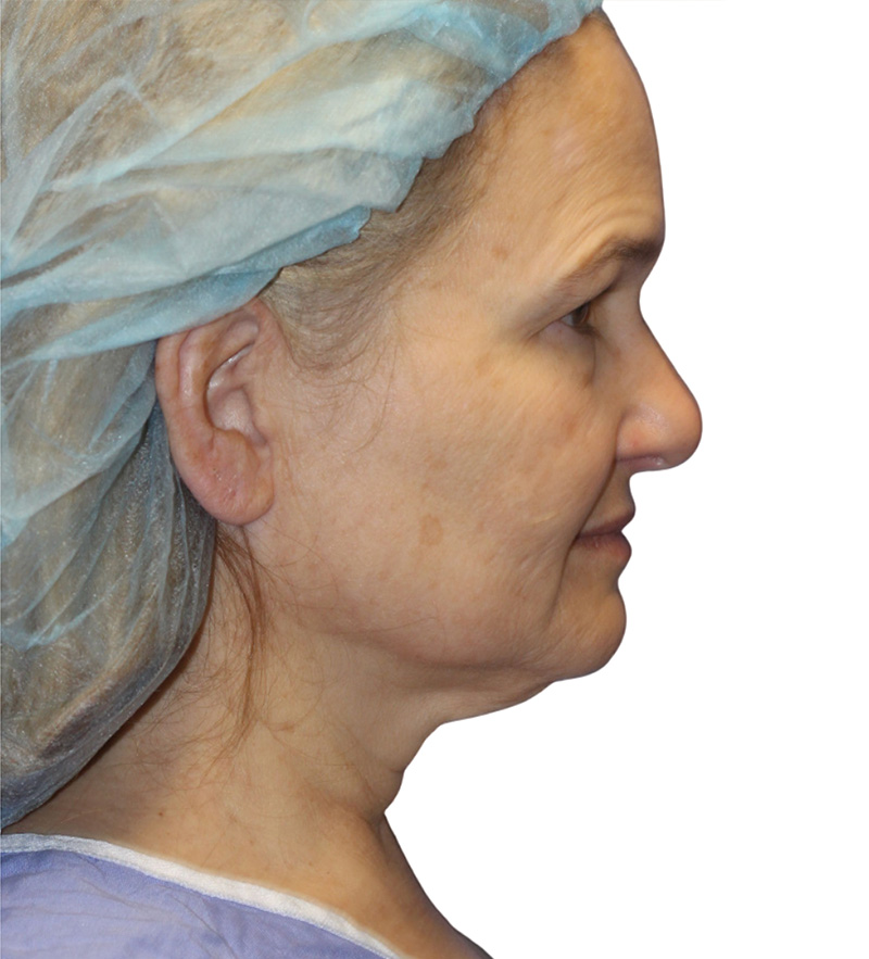 Facelift Before and After | PERK Plastic Surgery