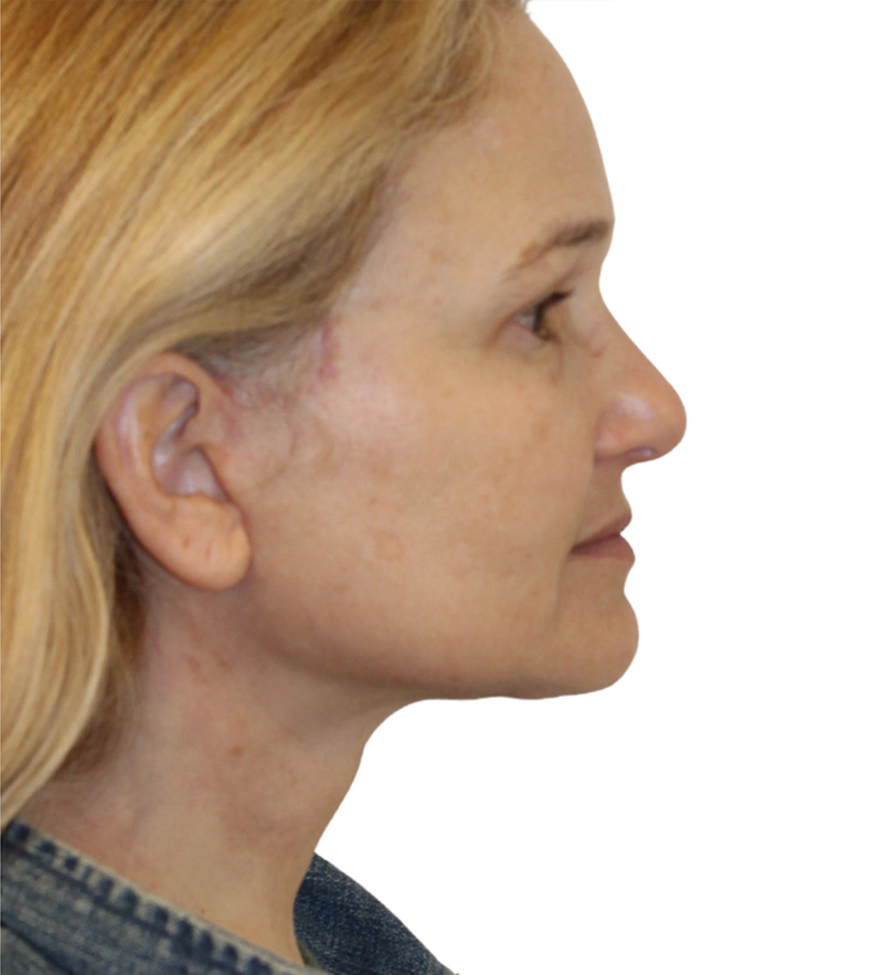 Facelift Before and After | PERK Plastic Surgery