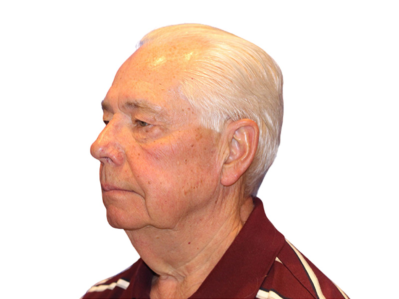 Facelift Before and After | PERK Plastic Surgery