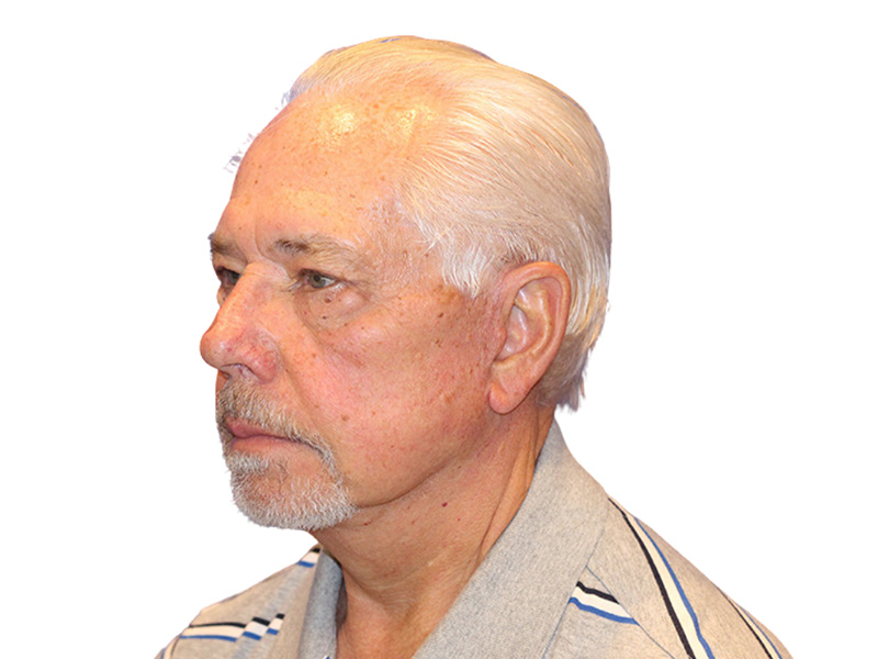 Facelift Before and After | PERK Plastic Surgery