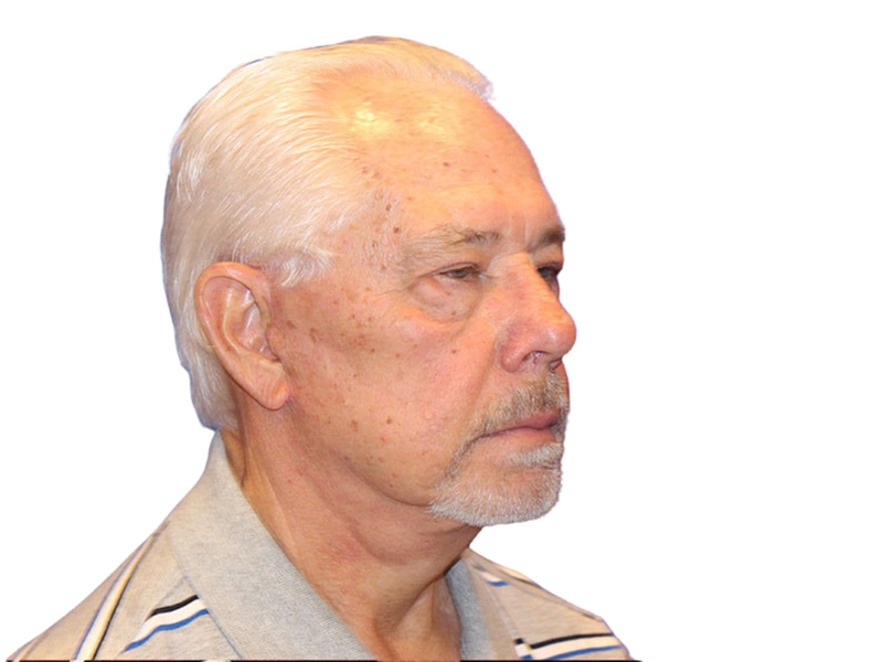 Facelift Before and After | PERK Plastic Surgery