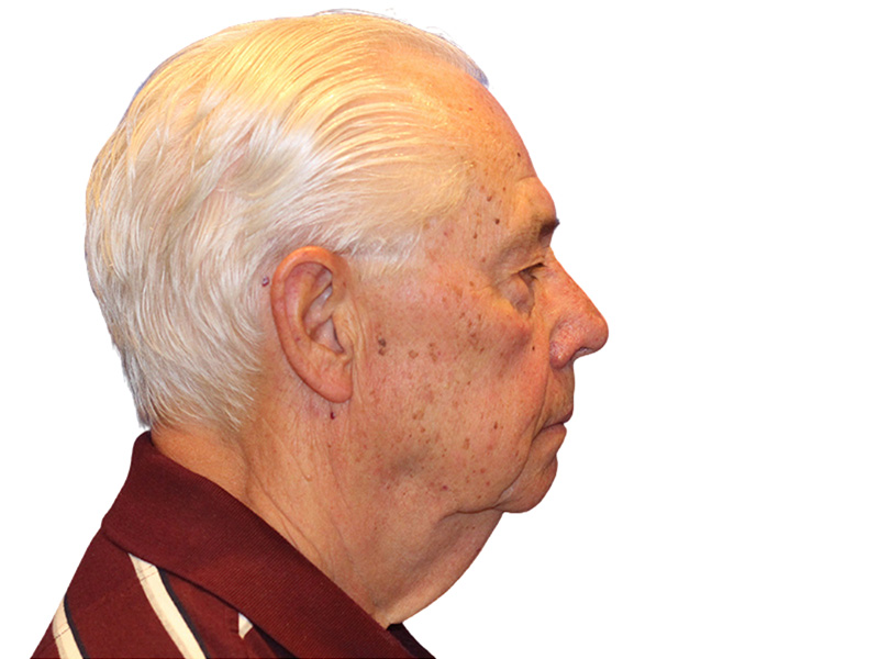 Facelift Before and After | PERK Plastic Surgery